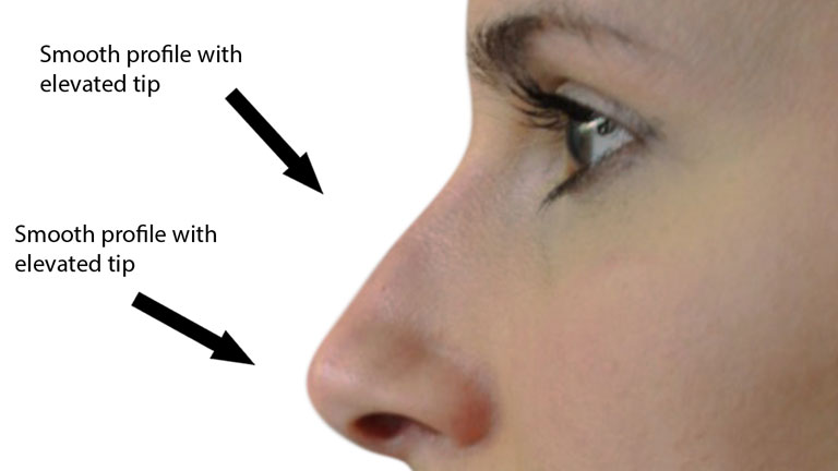 after-nose-fillers,-nose-fillers-by-healthista.com