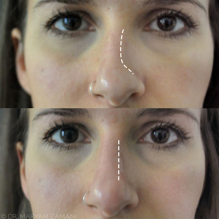 before-and-after-nose-filler-treatment-front,-nose-fillers-by-healthista.com