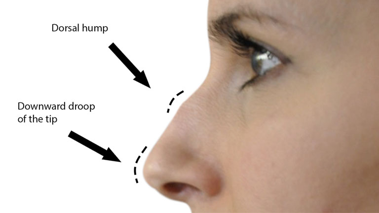 before-nose-filler-treatment,-nose-fillers-by-healthista.com