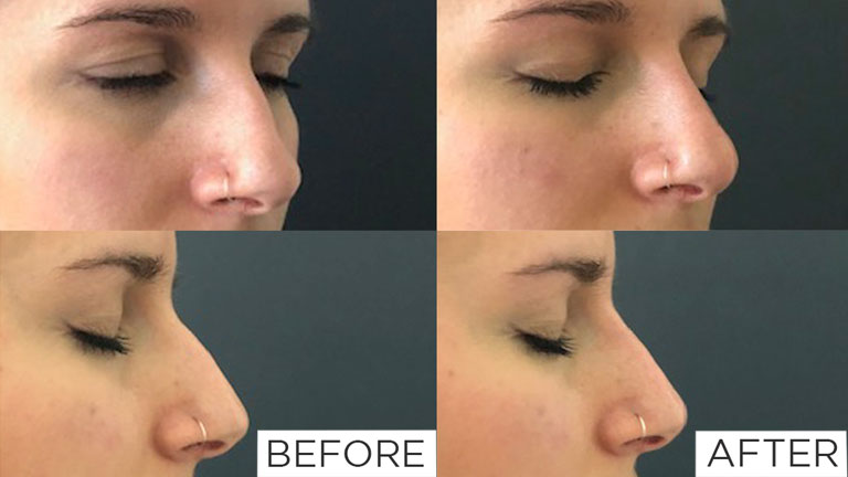 nose-filler-before-and-after,-nose-fillers-by-healthista.com